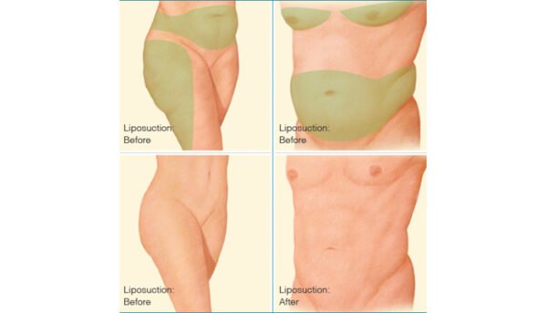 Liposuction Procedures